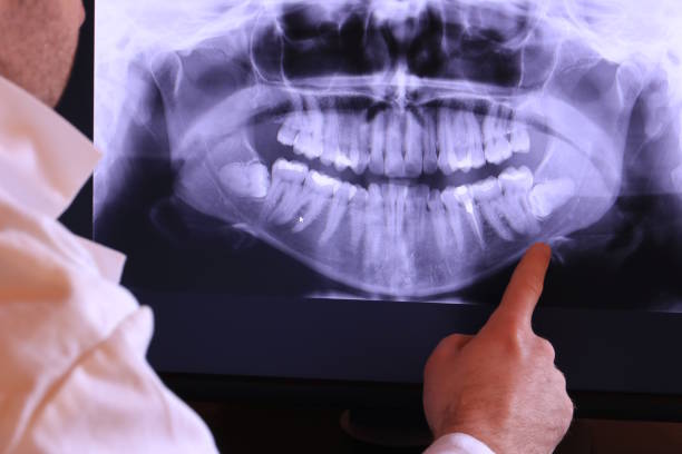 Best Emergency Wisdom Teeth Removal in Aberdeen, NC