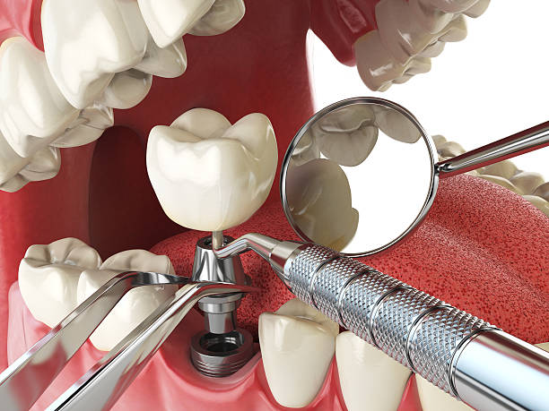 Best Emergency Tooth Extraction in Aberdeen, NC